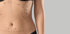 Liposuction Recovery and Results Timeline